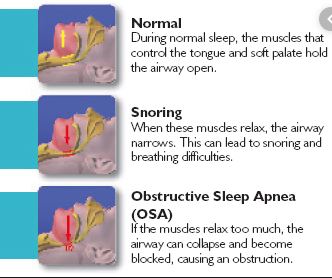 Difference Between Snoring And Apnea